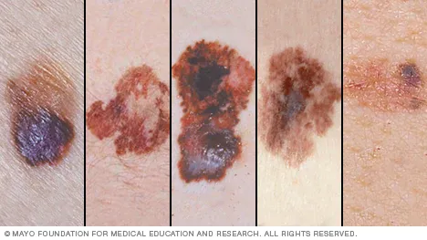 Skin Cancer