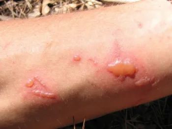 Phytophotodermatitus